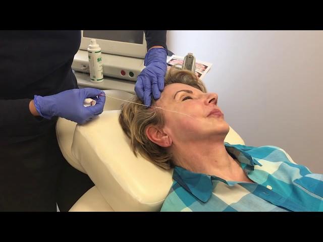 PDO Threadlift for midface lift with Dr. Shalini Gupta