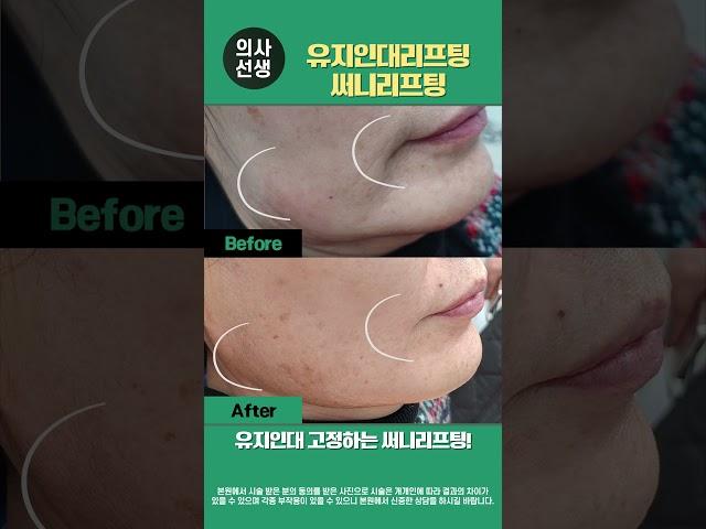 연신내피부과 유지인대리프팅 써니리프팅