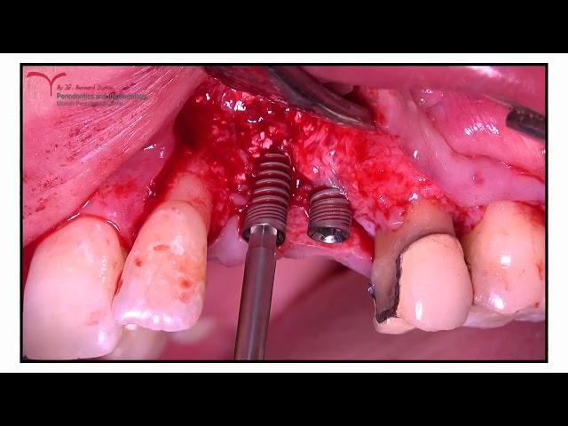 Implant Placement and GBR ( Allograft & Collagen membrane) by Dr Bernard Dahan