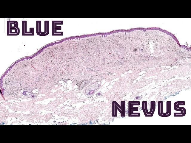 Blue Nevus under the microscope (blue/grey/black mole skin spot) pathology dermpath dermatology