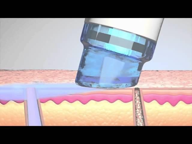 How does HydraFacial MD treatment work?