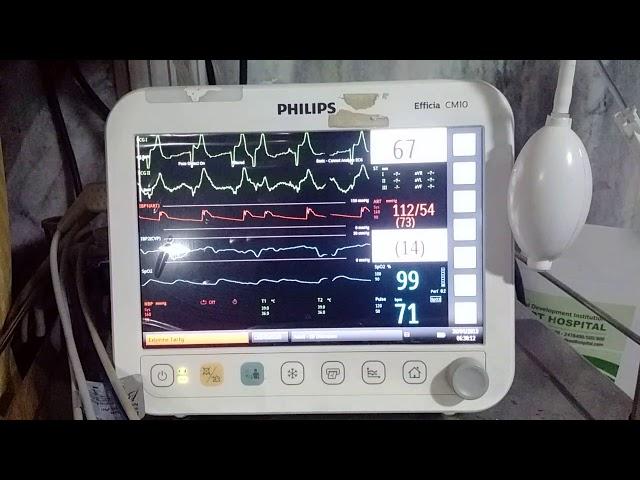 Broad QRS complex with irregular rhythm.