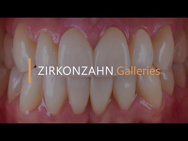 Minimally invasive restoration with ultra-thin zirconia veneers | Zirkonzahn.Galleries