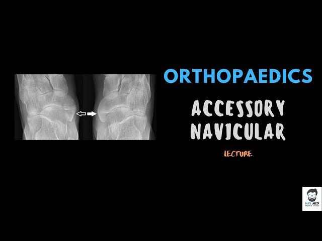 Accessory navicular Bone - Orthopaedics - Detailed Lecture