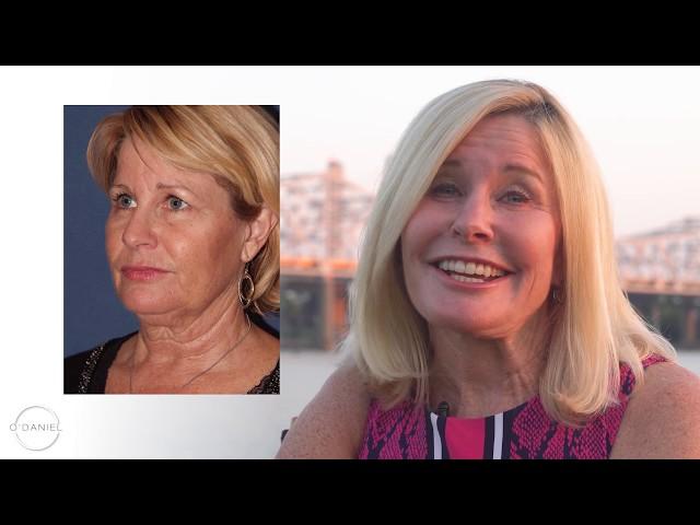 FACELIFT - NECKLIFT - Real Patient Story - Final Thoughts On Dr. O'Daniel