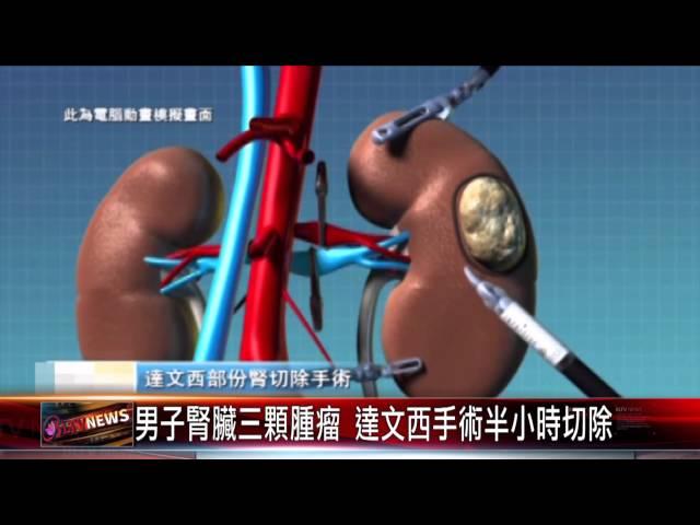 20150722 男子腎臟三顆腫瘤 達文西手術半小時切除