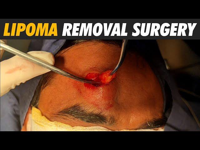 Forehead Lipoma removal | Permanent lipoma cure