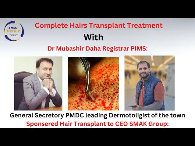 Hair Transplant || Treatment Expense || Experience || Tayyab Sethi CEO of Smak Group