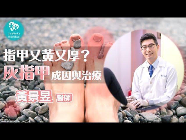 【指甲小學堂】天候潮濕，一個不小心灰指甲就找上你！｜ft 群英楊麗珍黃景昱皮膚科診所 黃景昱醫師