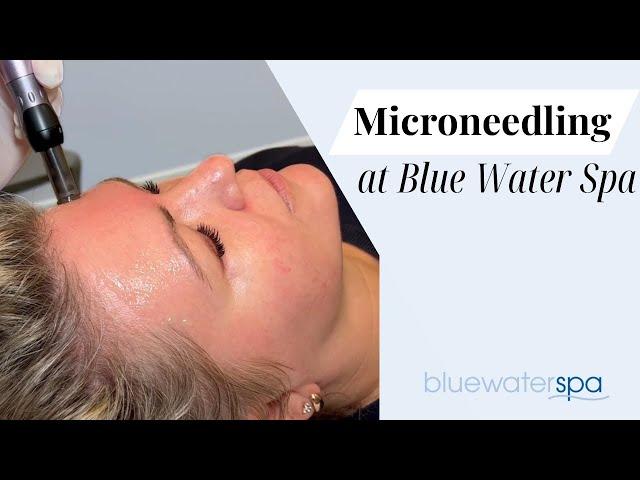 Microneedling at Blue Water Spa || Blue Water Spa Raleigh