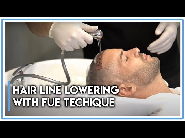 What is Expecting People in Istanbul who Comes for Hair Transplant [2019]