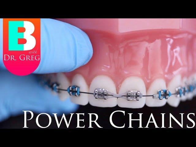 [BRACES EXPLAINED] Power Chains