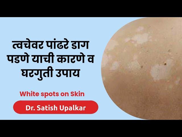 त्वचेवरील पांढरे डाग जाण्यासाठी घरगुती उपाय : डॉ सतीश उपळकर | White spots on Skin home remedies