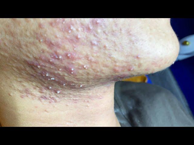 Acne Treatment For "Hung" (P7) | Điều Trị Mụn Cho Hùng (P7) -  SacDepSpa#202