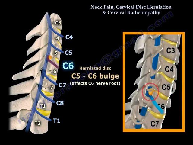 "Neck Pain, Cervical Disc Herniation, and Radiculopathy: Causes, Symptoms, and Treatment"