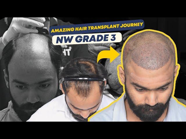 Hair Transplant in Ahmedabad | Best Results & Cost of Hair Transplant in Ahmedabad