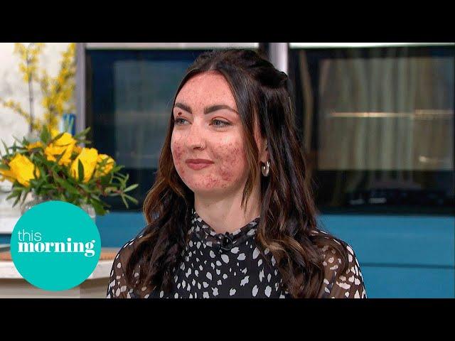 The Truth About Adult Acne: Expert Advice for Clear Skin | This Morning