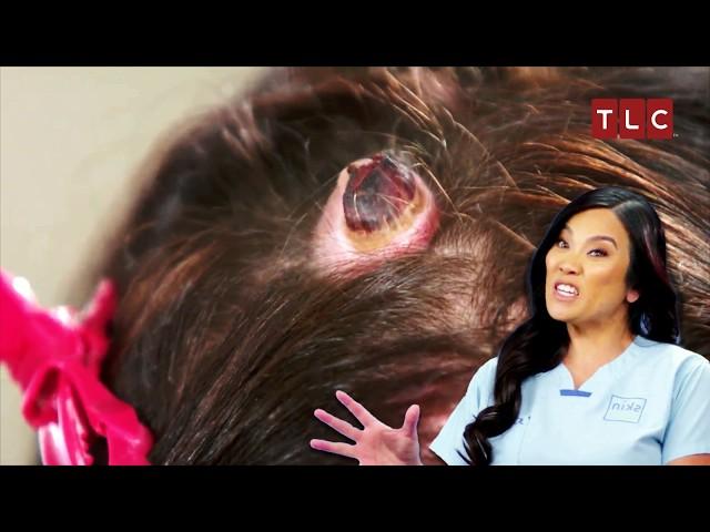 More Bumps Than Strands on Her Head! | Dr Pimple Popper TLC