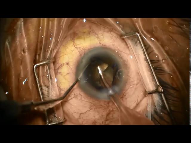 brown cataract and PXF with small pupil and phacodonesis, Dr. Hassan Adel khaled