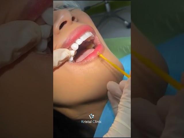 Hollywood smile makeover - dental teeth veneers