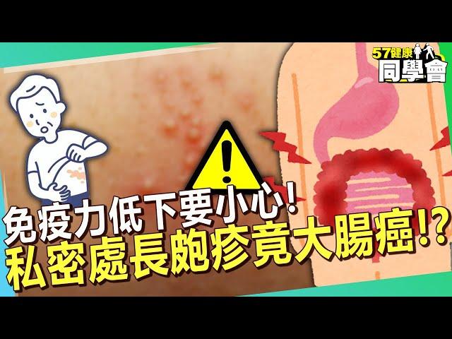 免疫力低下要小心！私密處長皰疹竟檢出大腸癌？！【 @57healthy  】#趙國翔 醫師