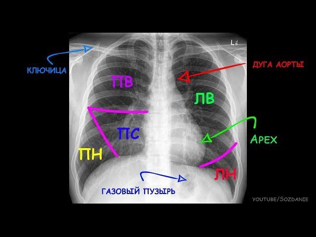 Рентгеноанатомия грудной клетки за 5 минут