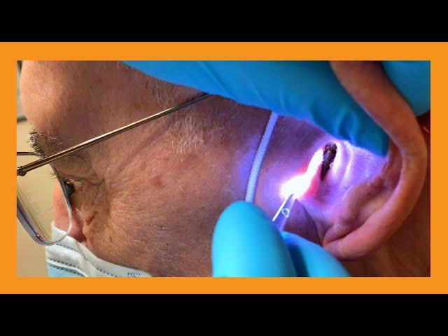 Dueling Cerumen Clearances | Auburn Medical Group