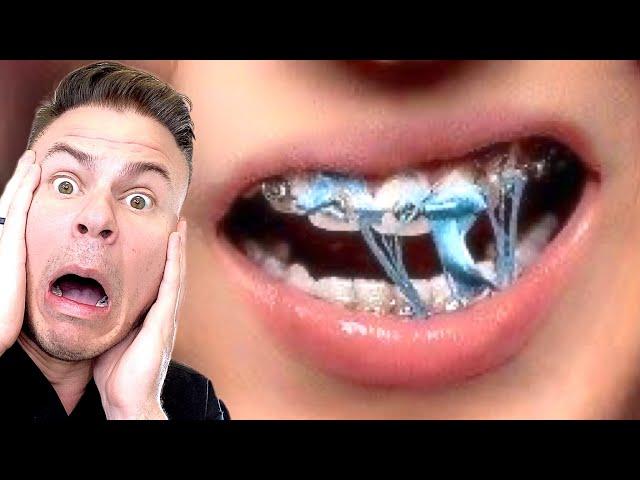 Why You Should NEVER Chew Gum With Braces