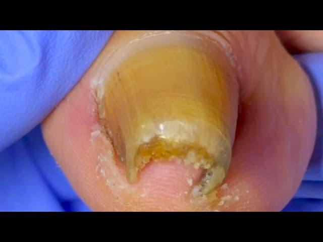 Super Curly Ingrown Toenails Trimmed! Solve Toe Troubles[Doctor Liu Pedicure]