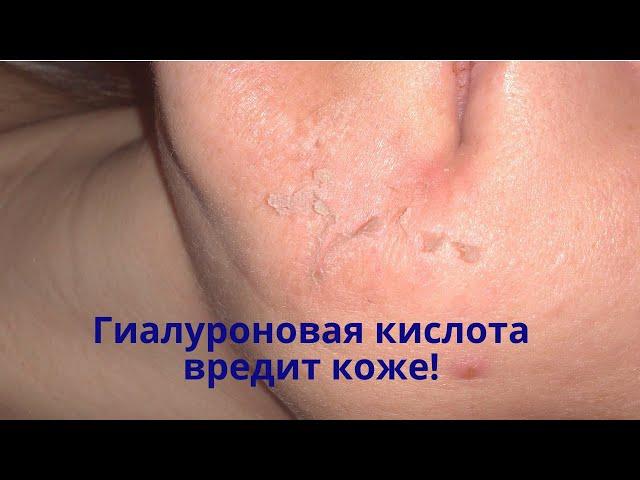 Почему гиалуроновая кислота вредит коже? Особенно зрелой и сухой коже.