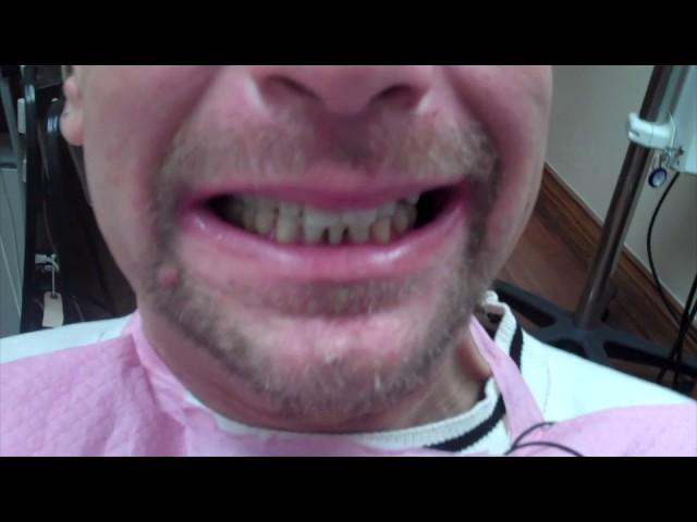 Severly loose teeth saved in 1 day