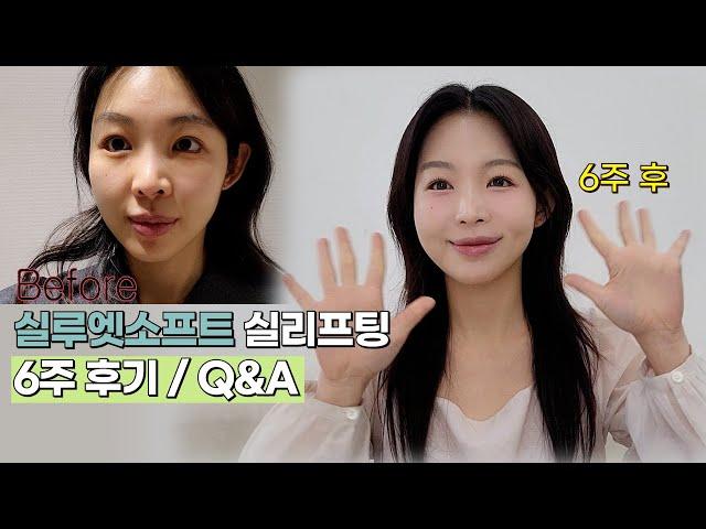 팔자/입가주름 뿌신 실루엣플리프팅(실리프팅) 6주 후기ㅣQ&A까지!!