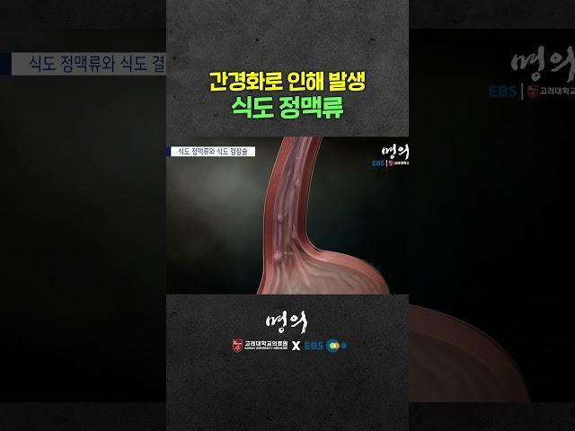 간이 안좋은데 식도에서 출혈이? 왜?