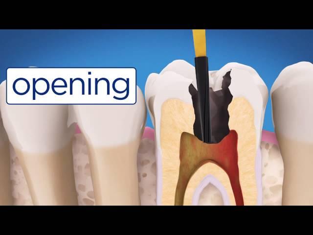 AAE Root Canal Treatment Video