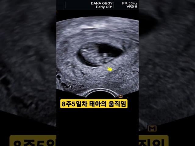 임신8주차 초음파ㅣ태아 다리 움직임
