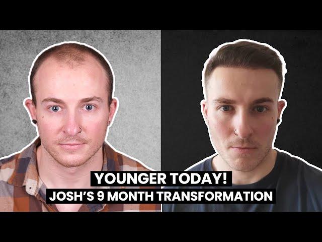 YOUNGER TODAY! Josh's 9 Month Results from Norwood V - 5! | Smile Hair Clinic