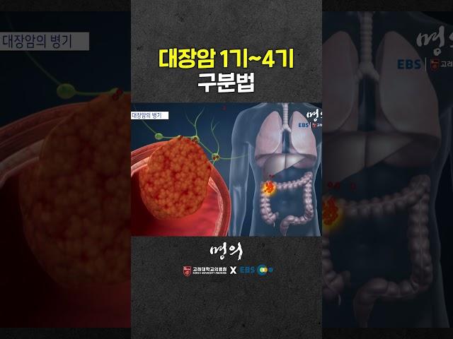 대장암 4기는 어떤 상황일까?