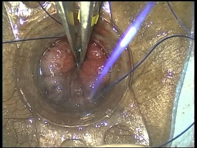 Stapled Hemorrhoidectomy for Prolapsing Hemorrhoids