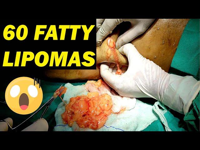 Multiple Body Lipoma Treatment !! 60 Fatty Lipomas Removal @Dezire Clinic