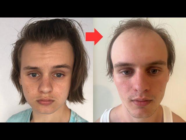 BALDING 17 to 19 Years Old