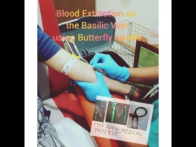 Blood extraction on the basilic vein using butterfly needle