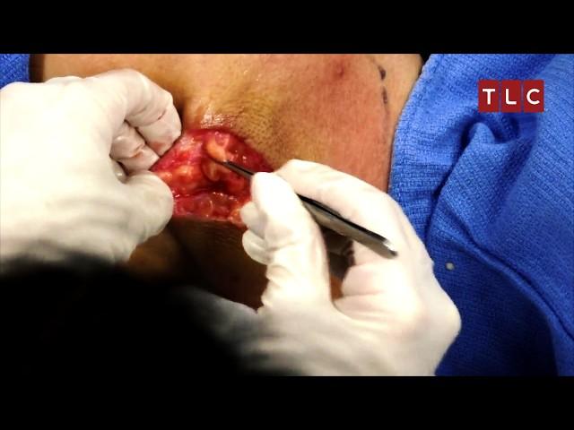 Bump That Grows Bigger with Time! | Dr Pimple Popper | TLC