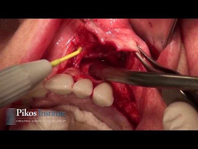 Maxillary Ridge Split - Pikos Institute