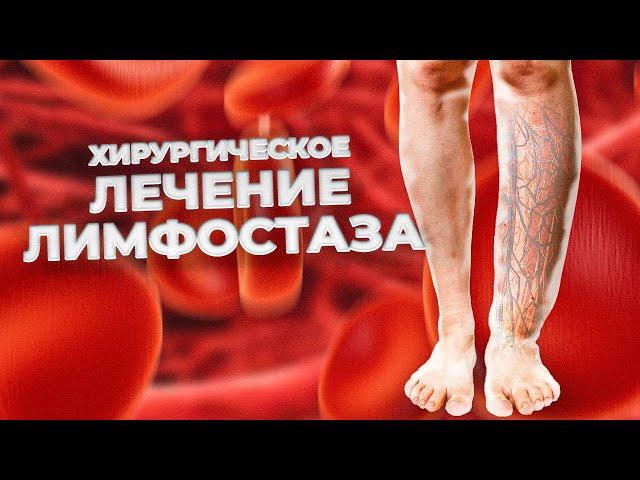 Лимфостаз: сильнейшее заболевание - разгадка . Как лечить?#рак #лимфостаз#лимфедема#лимфодренаж