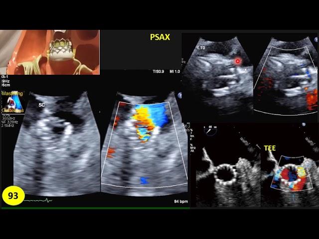 TAVR or TAVI 1: Echo evaluation