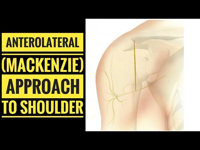 Anterolateral Approach to Shoulder (McKenzie Approach)