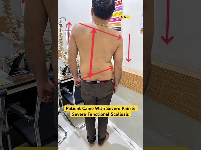 Severe sciatica with functional scoliosis case treatment byDrRavi #scoliosis #chiropractic #sciatica