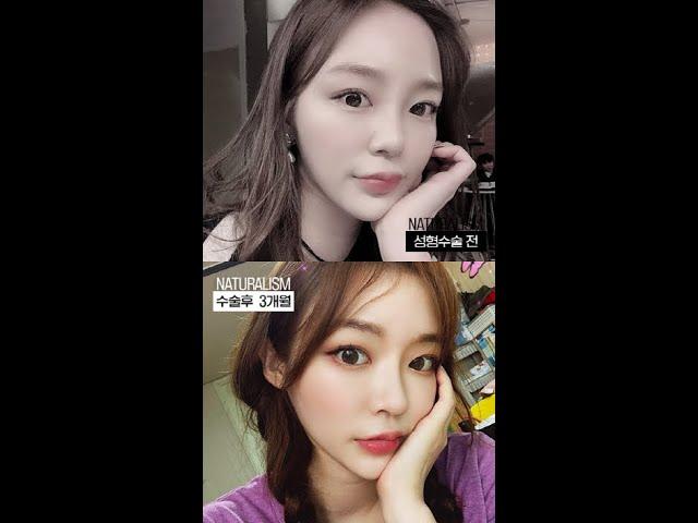 자연주의성형외과 코수술 +얼굴지방이식 성형전후영상