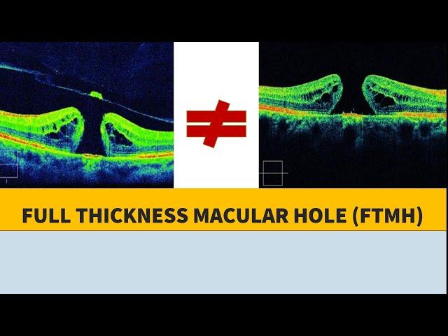 MACULAR HOLE BASICS & PATHOPHYSIOLOGY