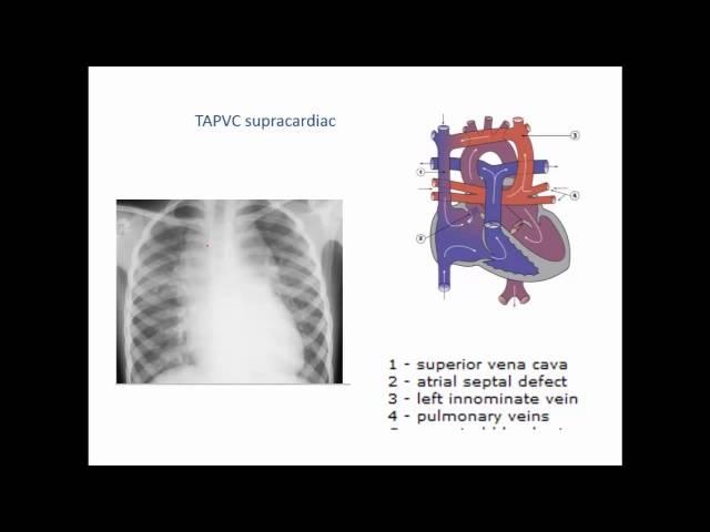 Total and Partial Anomalous Pulmonary Venous conne